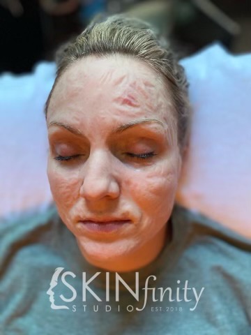 Botox Contour/RF Facial Combo $150