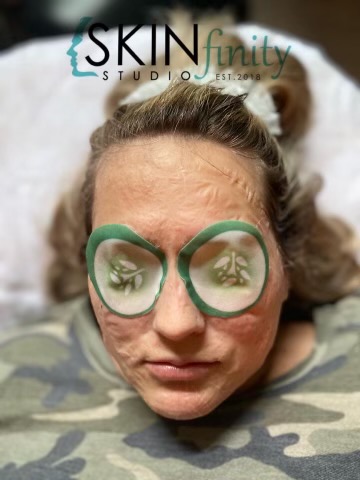RF and Glass Facial $150